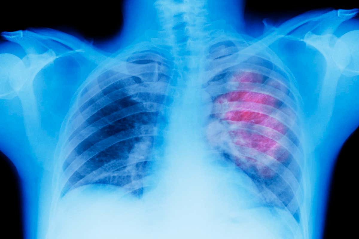 Radiografía de tórax que muestra cáncer de mama